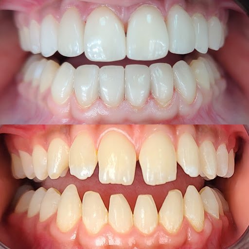 Dentist El Dorado - Main Street Implant & Family Dentistry El Dorado KS Dentist 4 Featured image