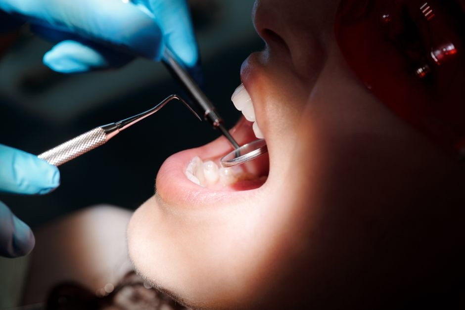dental tartar tips — Dental Tartar Tips: Prevent Build-Up & Freshen
